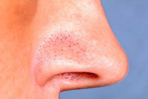 Blackheads